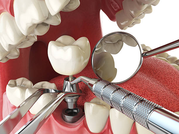 Best Emergency Root Canal Treatment in Manchaca, TX